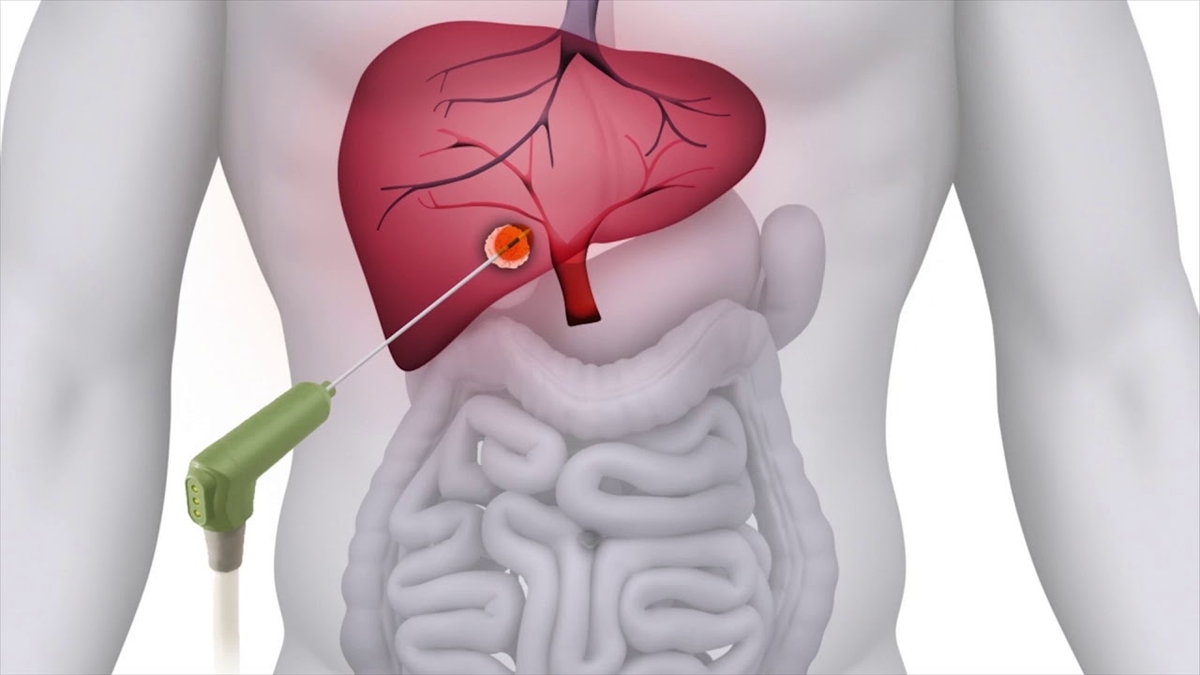 Bệnh viện điều trị ung thư gan tốt nhất Hà Nội