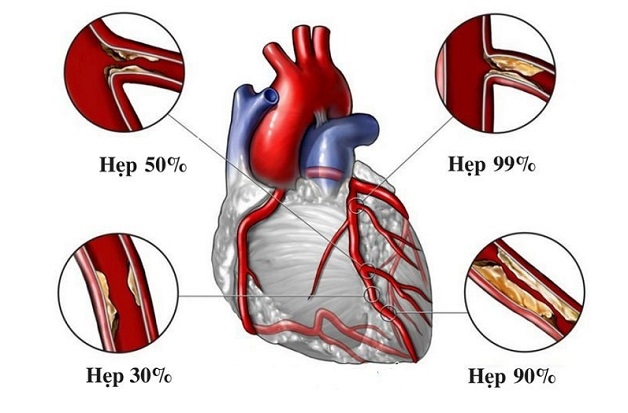 Các mức độ tắc hẹp trong bệnh lý mạch vành