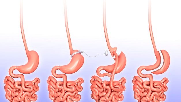 Tìm hiểu điều trị ung thư dạ dày ở đâu tốt nhất