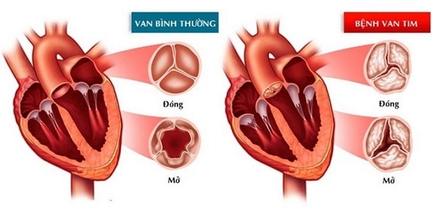 Hở van tim là tình trạng các van tim không thể đóng hoàn toàn khi co bóp, dẫn đến máu trào ngược lại buồng tim.