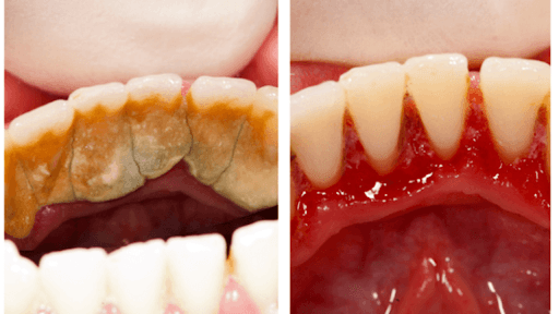 Sự khác biệt trước và sau khi lấy cao răng