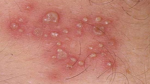 Một số dấu hiệu điển hình của mụn rộp sinh dục nam bao gồm: Nổi mụn nước, ngứa ngáy, đau nhức…