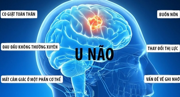 U não có thể là nguyên nhân gay ho đau nửa đầu.