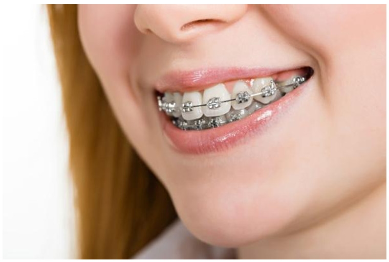 Quá trình niềng răng cũng có một số hạn chế