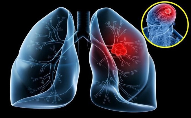 Phác đồ điều trị ung thư phổi hiện nay chủ yếu ngăn bệnh tiến triển nặng hơn