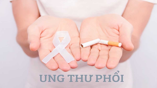 Phác đồ điều trị ung thư phổi: Những điều đáng chú ý
