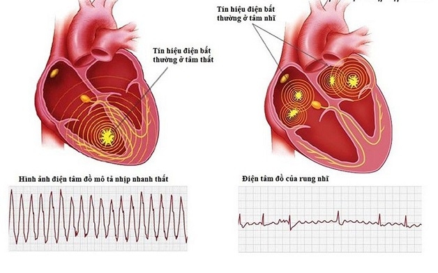 Điện tâm đồ là phương pháp phổ biến để chẩn đoán rối loạn nhịp tim.