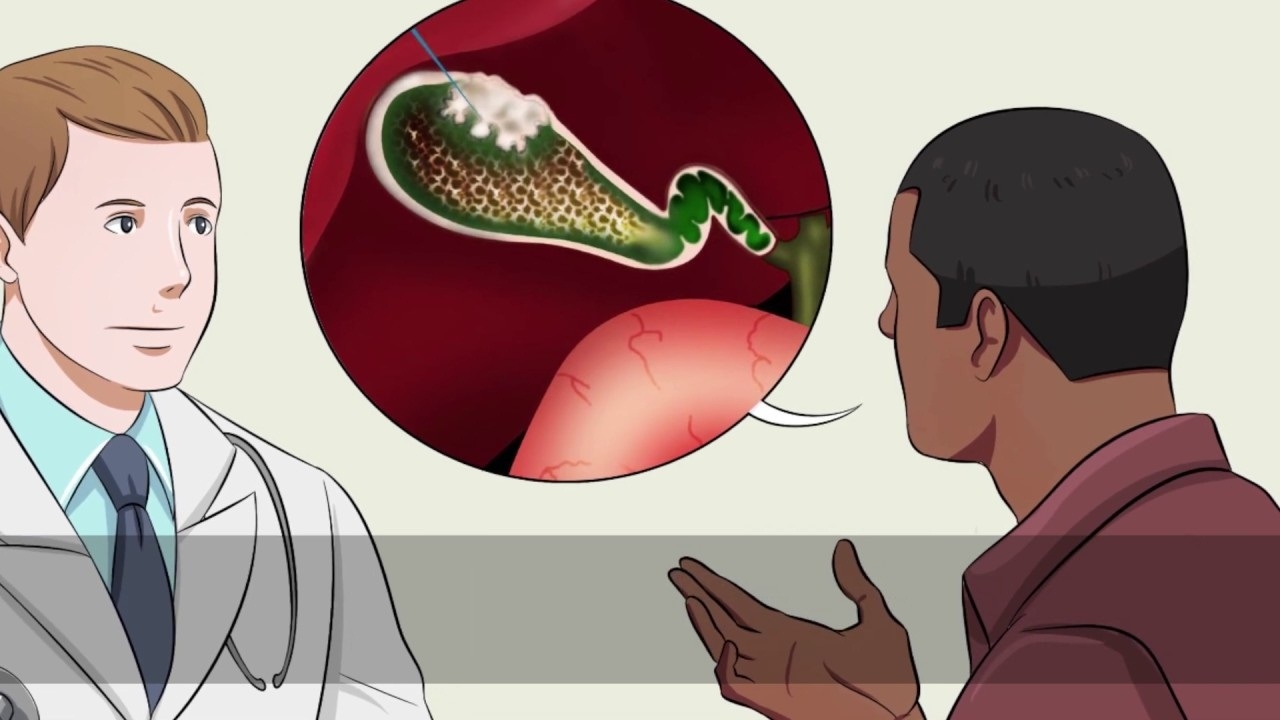  Polyp túi mật 5mm có nguy hiểm không? &#8211; Góc giải đáp