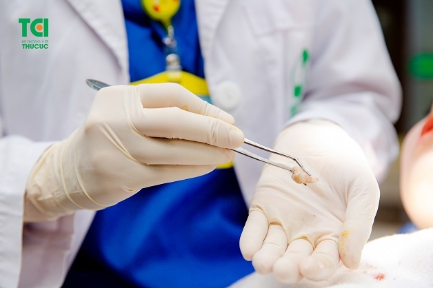 Răng khôn có cần nhổ không phụ thuộc vào tình trạng mọc và những ảnh hưởng của nó tới sức khỏe răng miệng