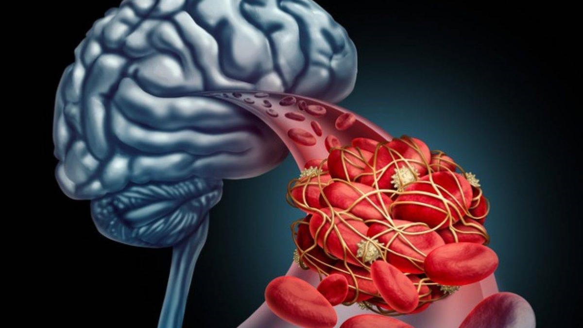 Tại sao bệnh thiếu máu não gây đau đầu? Cách cải thiện