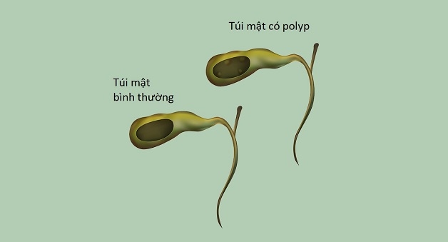 Các triệu chứng polyp túi mật