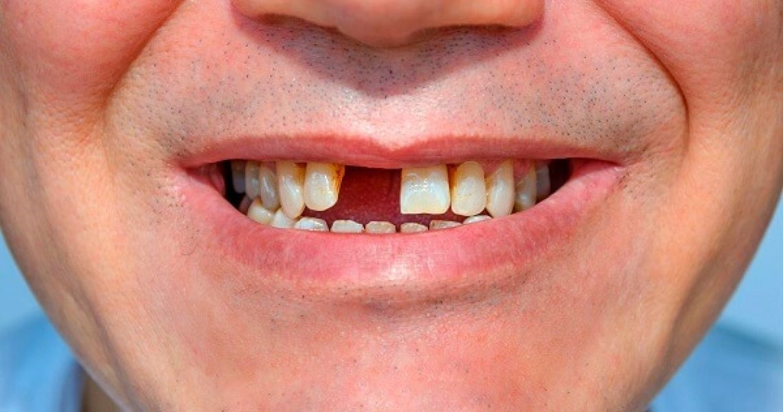 Trồng răng nào tốt nhất luôn là nỗi băn khoăn của nhiều người bị mất răng
