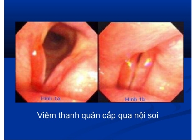 Viêm thanh quản