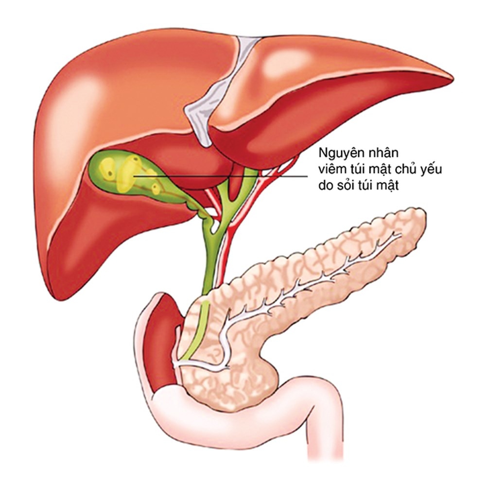 Viêm túi mật do sỏi lý do là gì