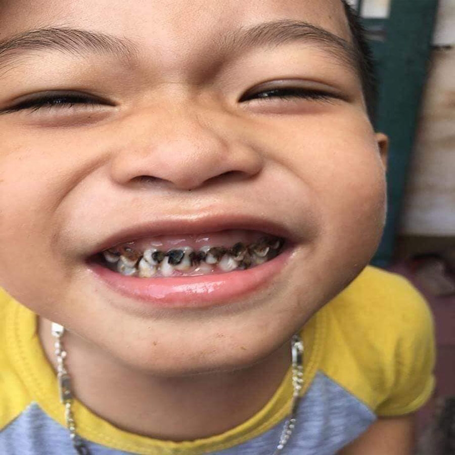 Sâu răng là nguyên nhân hàng đầu của trình trạng viêm tủy răng sữa ở trẻ