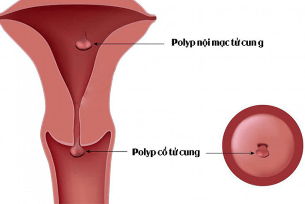 Cắt polyp cổ tử cung hết bao nhiêu tiền