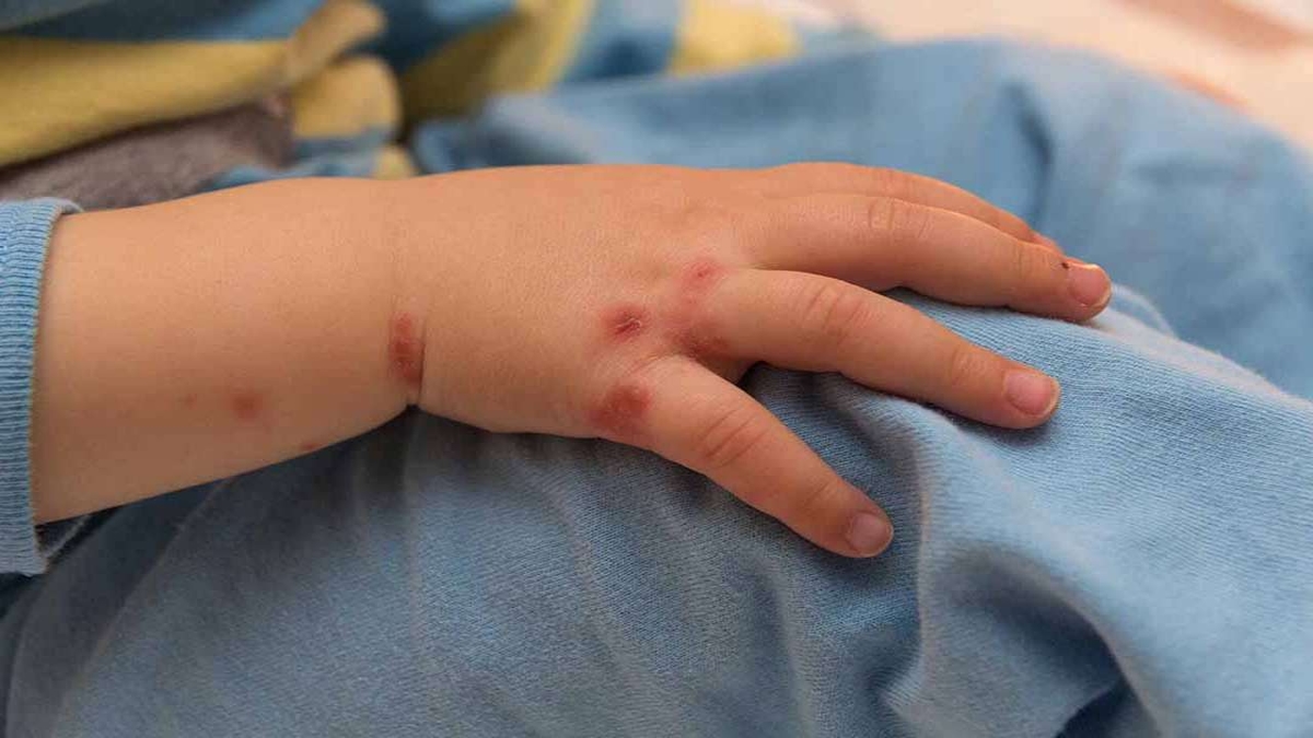 Bệnh tay chân miệng lây như thế nào? Dấu hiệu của bệnh là gì?