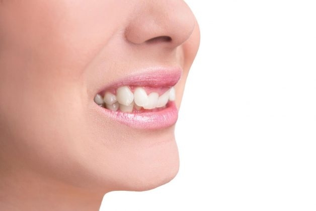 Răng khểnh là một loại răng nanh, mọc ở những vị trí bất thường trên cung hàm
