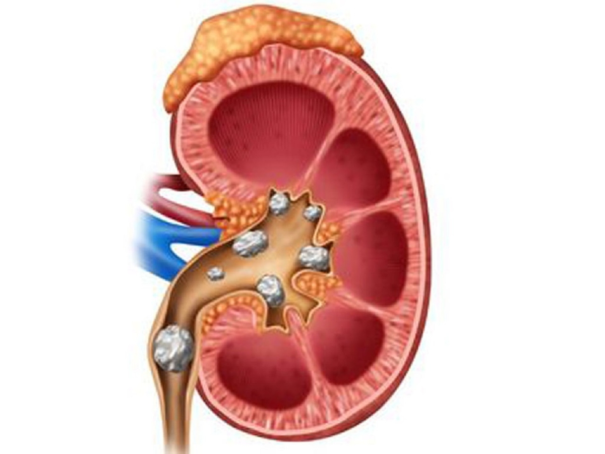 Sỏi kẹt niệu quản có nguy hiểm không &#8211; Góc giải đáp