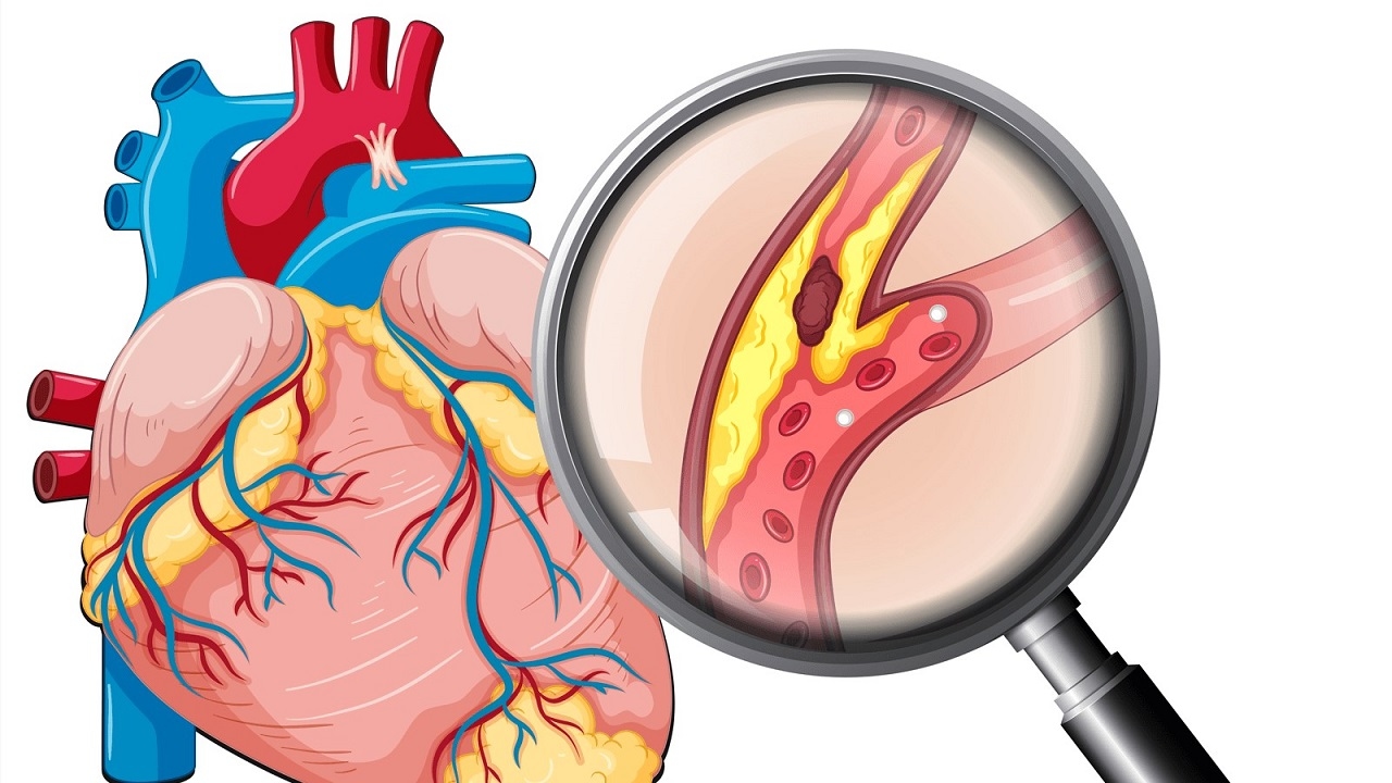 Không thể chủ quan với bệnh hẹp mạch vành