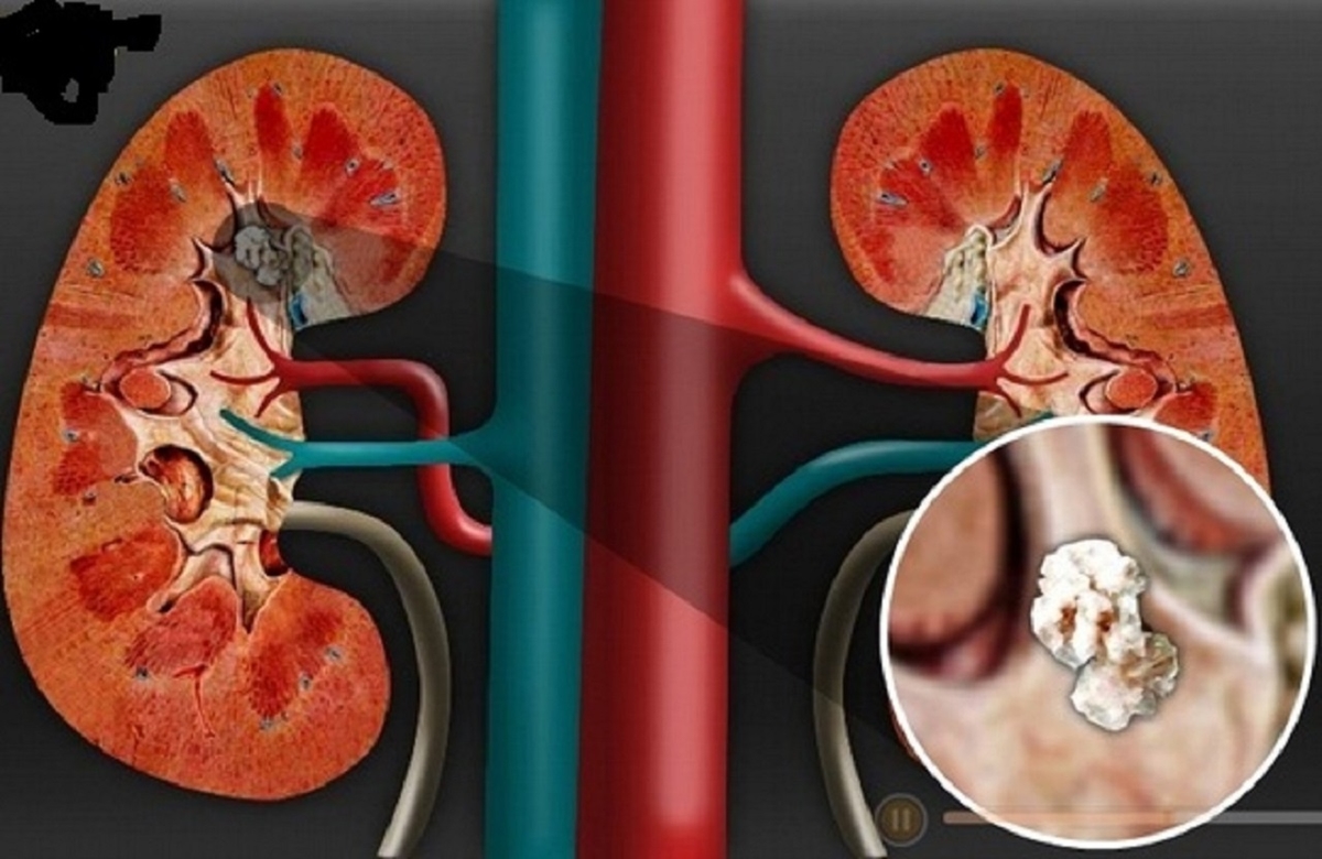 Bệnh sỏi thận &#8211; chẩn đoán và điều trị hiệu quả