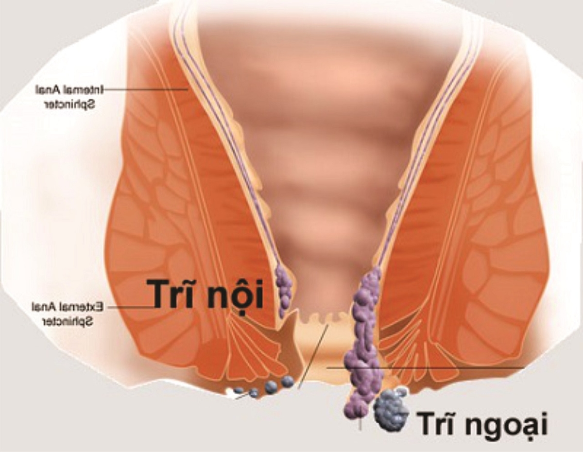 Bệnh trĩ chảy máu điều trị thế nào? &#8211; Góc giải đáp