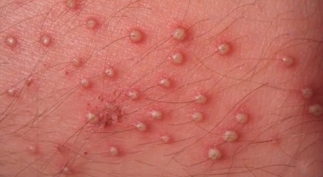 Ngứa vùng háng ở nam là hiện tượng háng bị đỏ rát, hoặc xuất hiện vết sần và các nốt mụn nước.