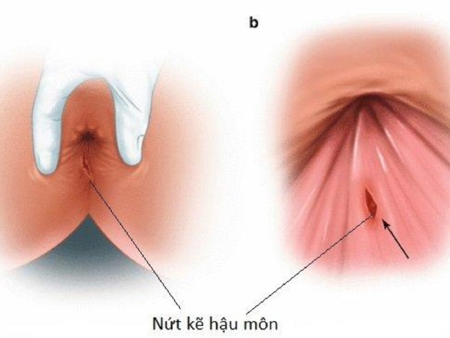 Bị nứt kẽ hậu môn phải làm sao? &#8211; Góc giải đáp
