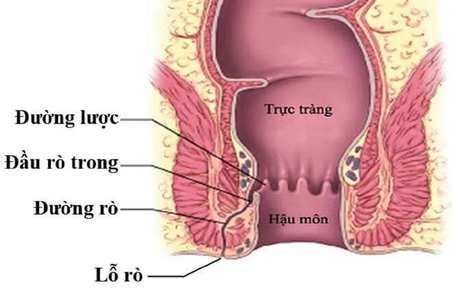 Điều trị rò hậu môn hiệu quả bằng cách nào &#8211; Góc giải đáp