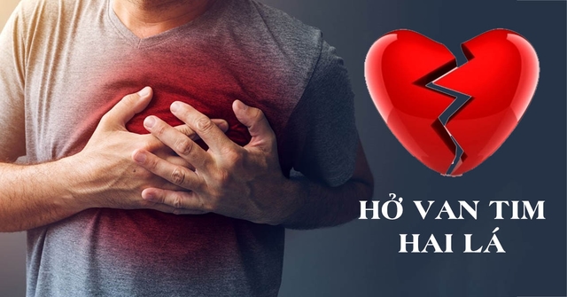 Phân biệt hở và hẹp van tim cùng cách điều trị, phòng ngừa