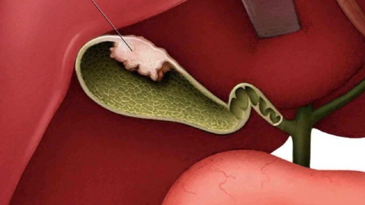 Polyp túi mật khi mang thai &#8211; Mẹ bầu cần lưu ý gì?