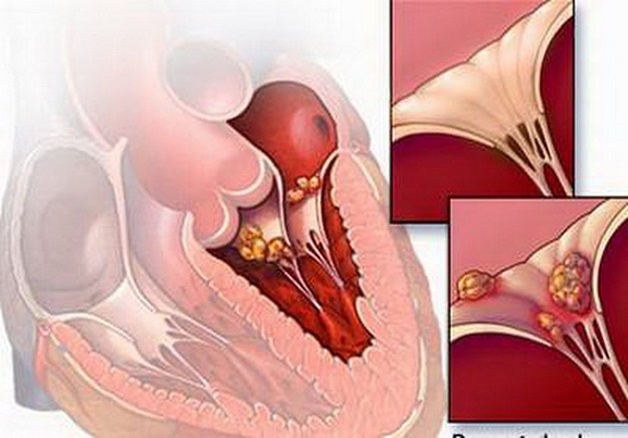 Bệnh thấp tim nếu không được điều trị kịp thời có thể gây ra những biến chứng nghiêm trọng tại tim.