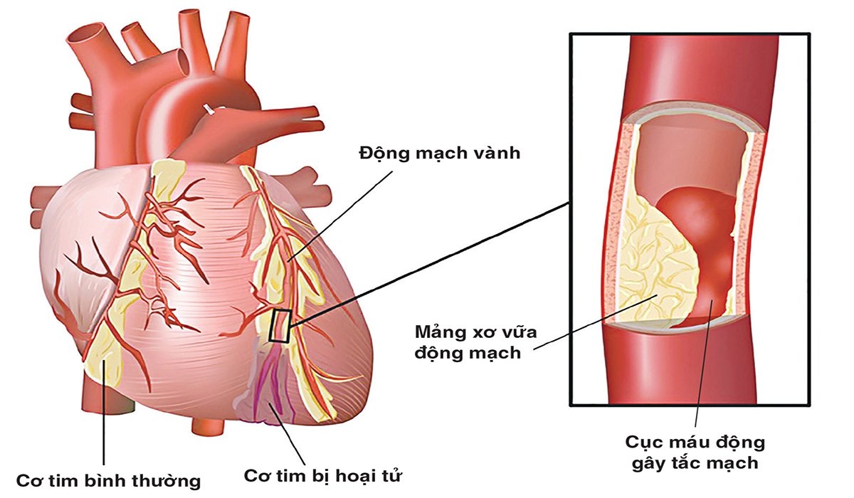 Xơ cứng động mạch vành – bệnh tim mạch phổ biến và nguy hiểm