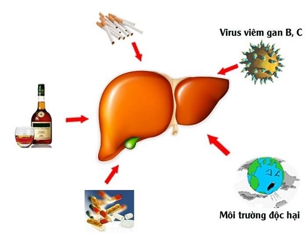Có nhiều nguyên nhân gây ra xơ gan