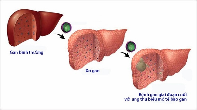 Ung thư gan là biến chứng nguy hiểm của bệnh lý xơ gan, có tiên lượng xấu với tỷ lệ tử vong rất cao