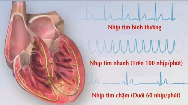 Thông thường, nhịp tim dưới 60 nhịp/phút thì được gọi là tim đập chậm.