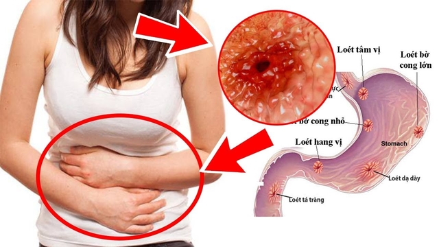 Đau dạ dày đau bên nào? &#8211; Góc giải đáp