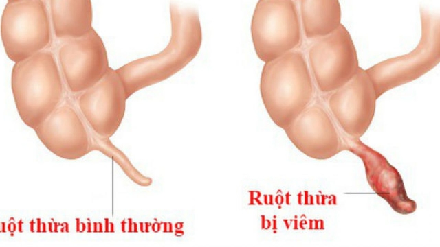Đau ruột thừa ở bên nào &#8211; xử trí khi gặp cơn đau ruột thừa