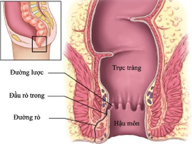 Nguyên nhân rò hậu môn và cách xử trí