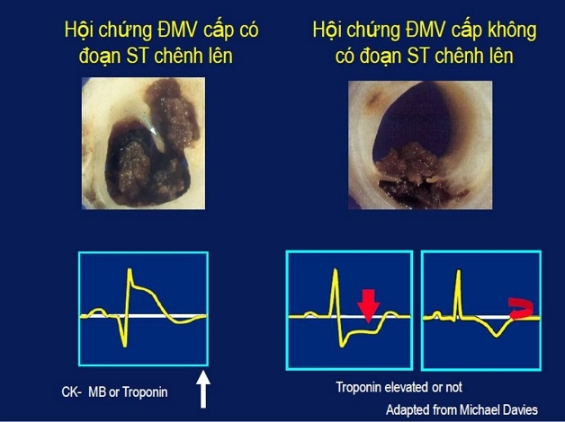 Nhồi máu cơ tim ST chênh lên là gì?