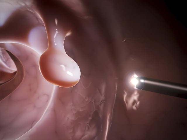 Polyp đại trực tràng gồm những loại nào? Cách phòng tránh