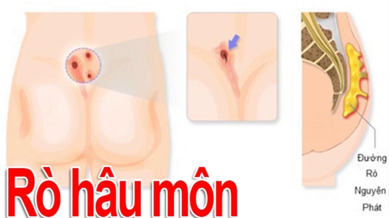 Rò hậu môn là thế nào? &#8211; Góc giải đáp