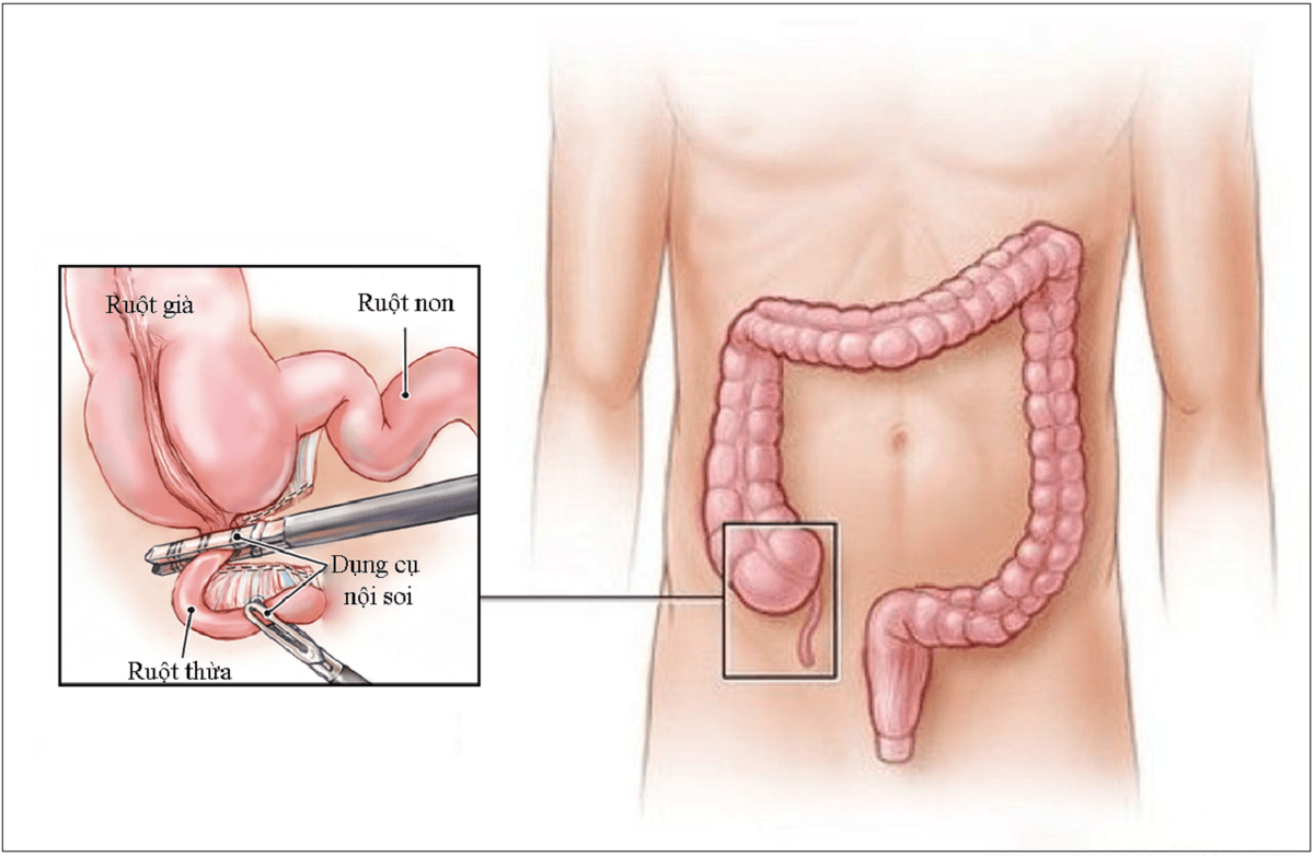 Viêm ruột thừa cấp có phải mổ hay không?