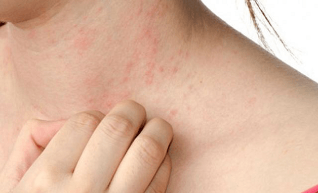 Nổi mề đay cũng là dấu hiệu của xơ gan độ 1