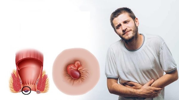 Các cấp độ bệnh trĩ nội và trĩ ngoại