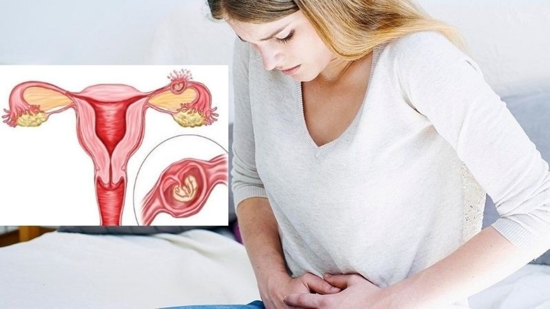 Dấu hiệu thai ngoài tử cung bị vỡ &#8211; Mẹ bầu cẩn trọng!