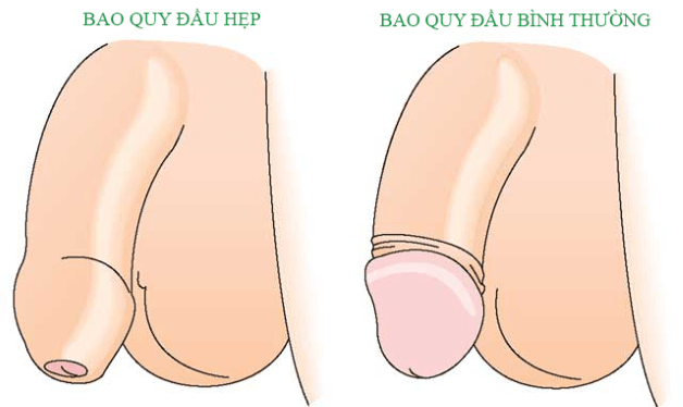 Hẹp bao quy đầu ở nam giới