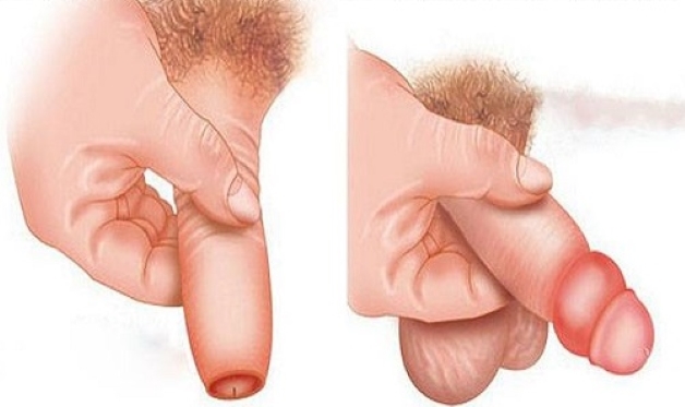 Sưng bao quy đầu ở nam giới