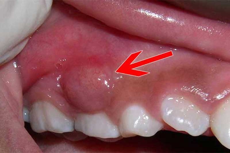 Áp xe nướu răng