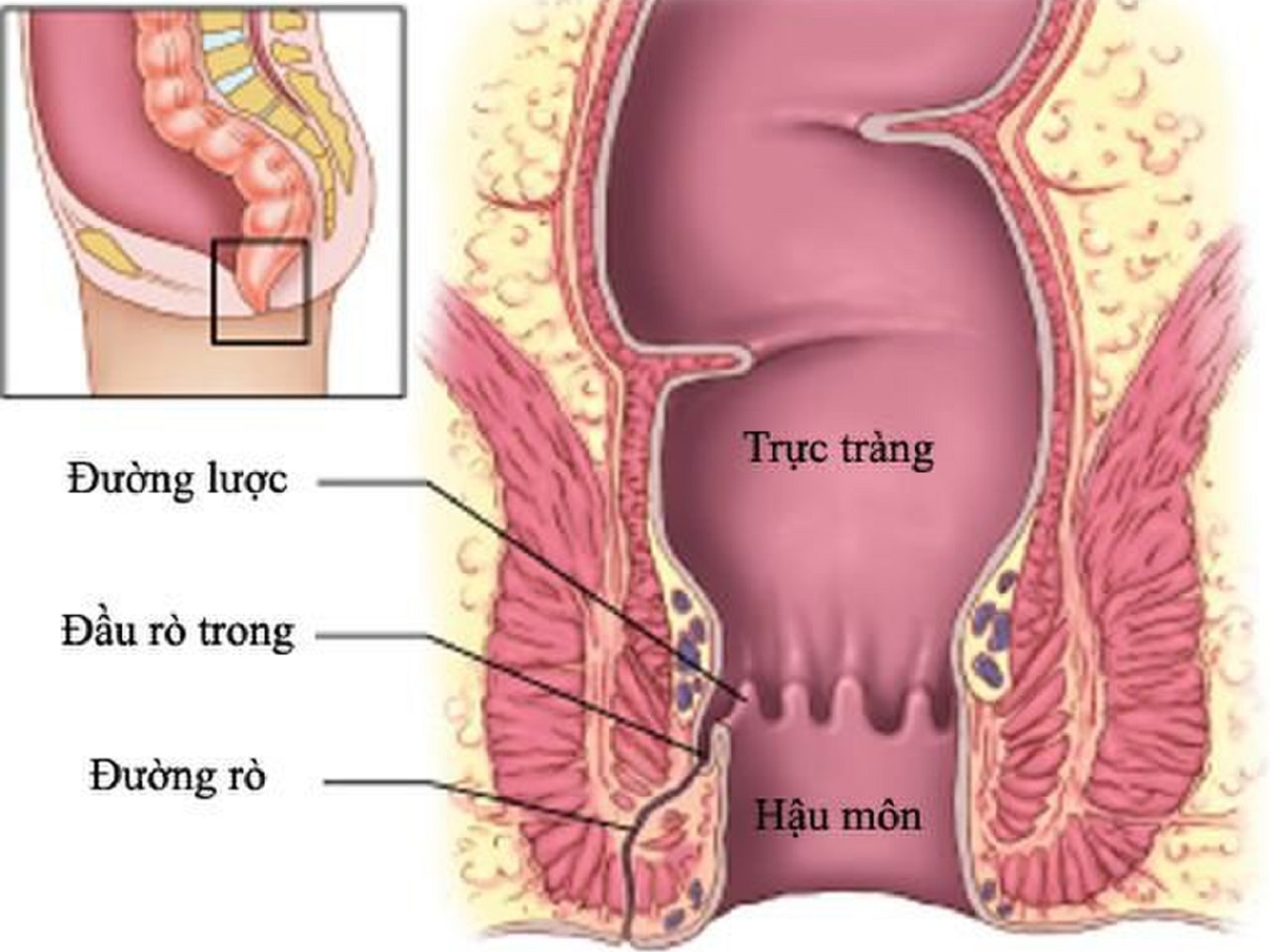 Bệnh rò ở hậu môn và những điều cần biết